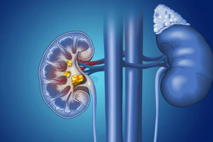 Kidney Stones: Causes, Symptoms, and Natural Ways to Prevent Them